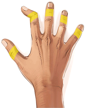 Handkirurgiskt diagnosstöd: extensionsdefekt i fingertopp