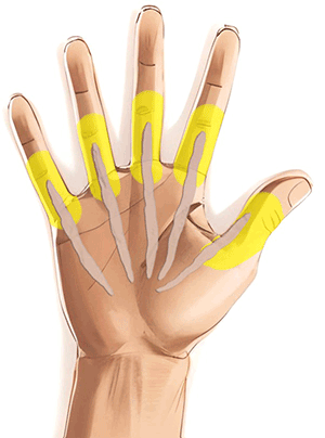 Handkirurgiskt diagnosstöd: extensionsdefekt i handflata