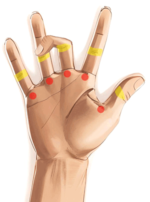 Handkirurgiskt diagnosstöd: upphakning i finger