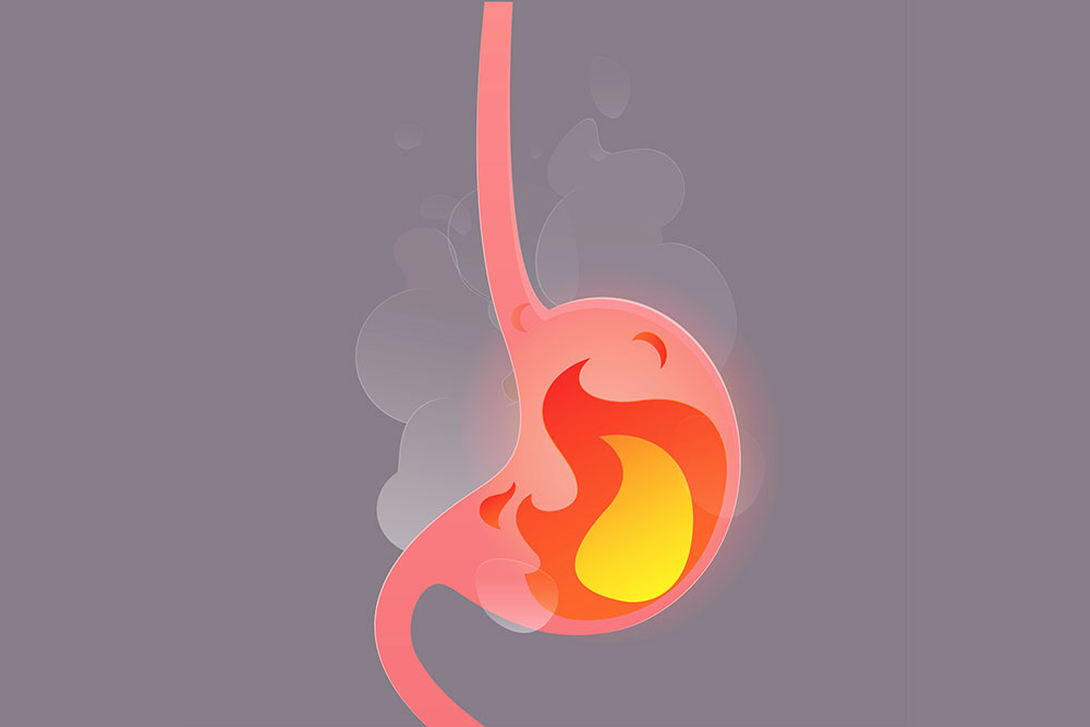 Illustration till vårdprogram gastroesofageal reflux