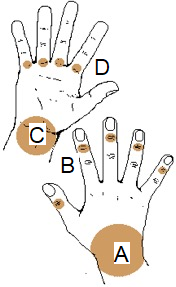 Bilden visar vanliga lokalisationer för ganglion på hand och fingrar (volart och dorsalt)